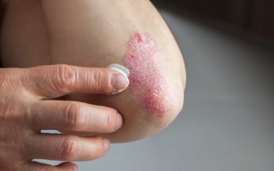 UCB autorisé à commercialiser son médicament contre le psoriasis au Japon
